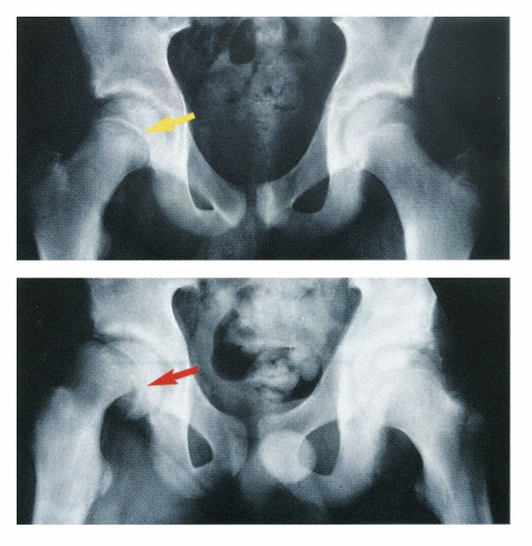 Femur Başı Epifiz Kayması