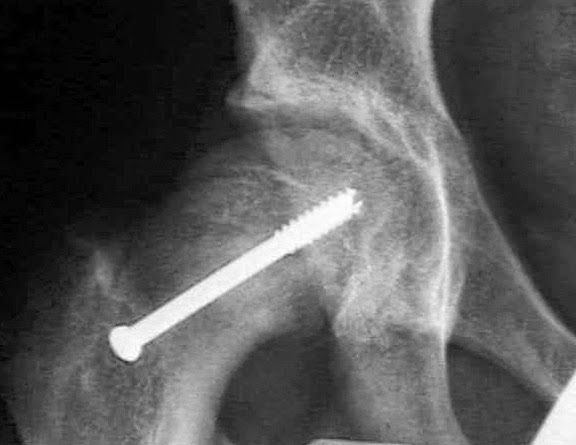 Femur Başı Epifiz Kayması