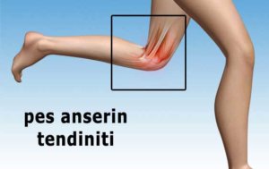 pes anserin tendiniti