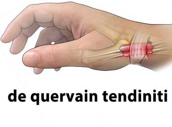 de quervain tendiniti