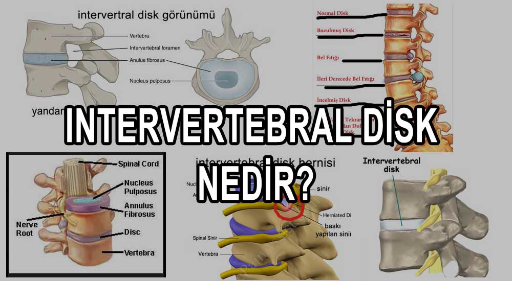 intervertebral disk nedir