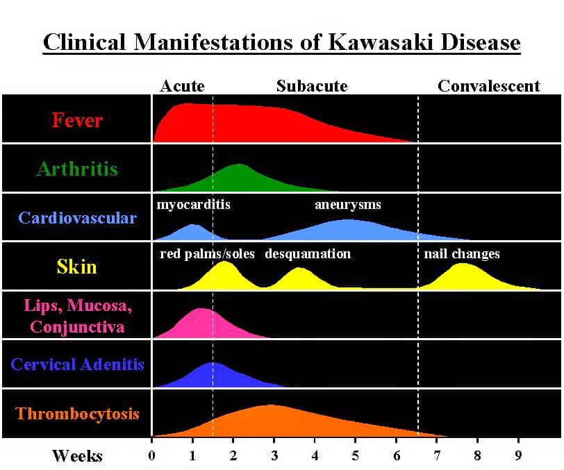 kawasaki hastalığı tanı kriterleri